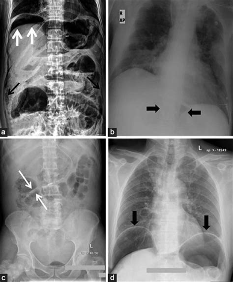 Pneumoperitoneum Definition Causes Symptoms Diagnosis Treatment Pneumoperitoneum Definition Causes Symptoms Diagnosis Treatment